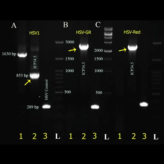 Herpes Simplex Virus (HSV) Type 2 DNA PCR